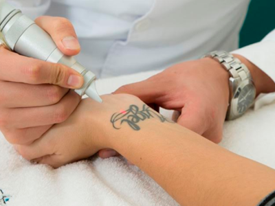 Eliminación de Tatuajes