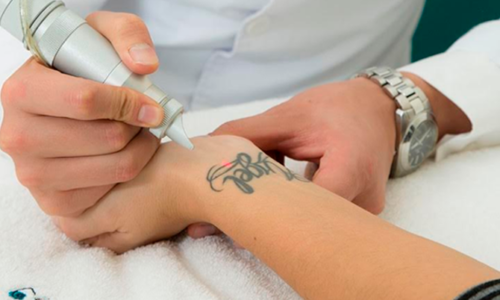 Eliminación de Tatuajes