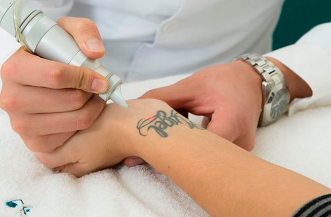 laser-eliminacion-tatuajes1