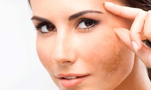Melasma