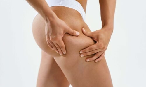 Celulitis