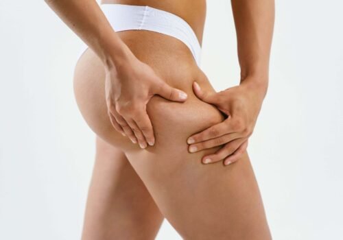 Celulitis