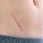 Abordaje y Manejo de cicatrices