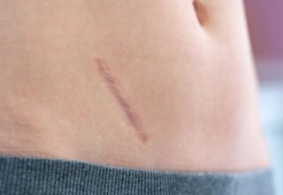 Abordaje y Manejo de cicatrices