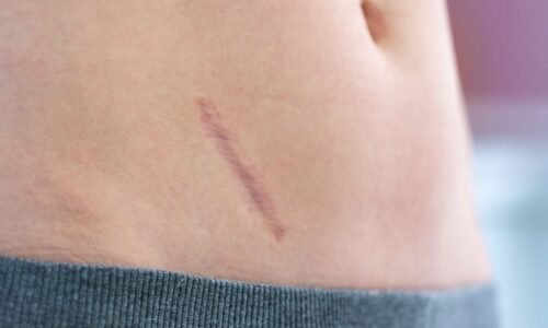 Abordaje y Manejo de cicatrices